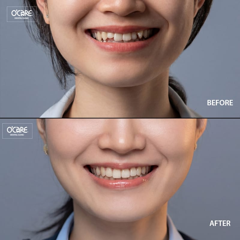 Niềng răng khớp cắn ngược 2