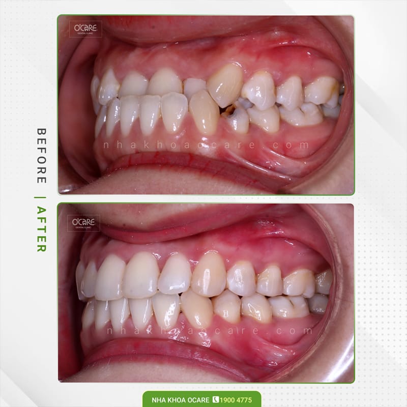 Niềng răng khớp cắn ngược 2