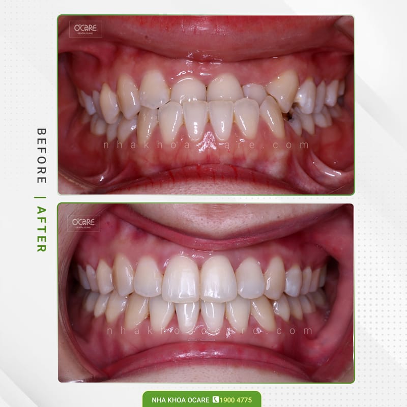 Niềng răng khớp cắn ngược 2