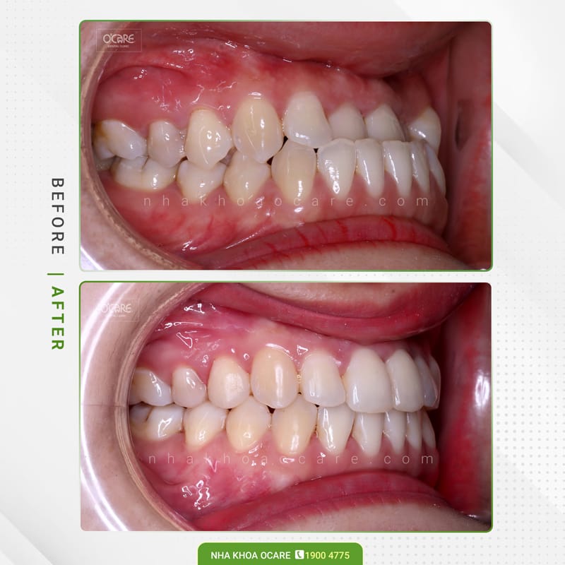 Niềng răng khớp cắn ngược 2