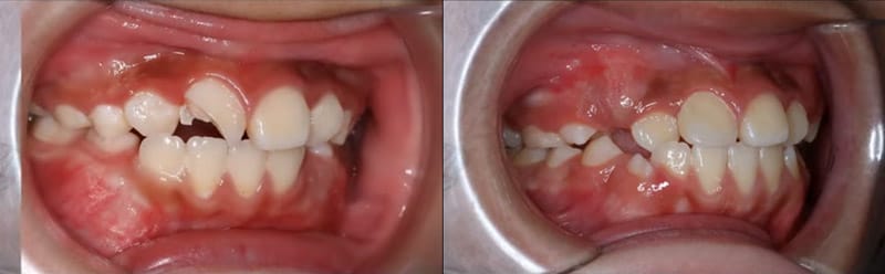 Trám gãy răng cửa