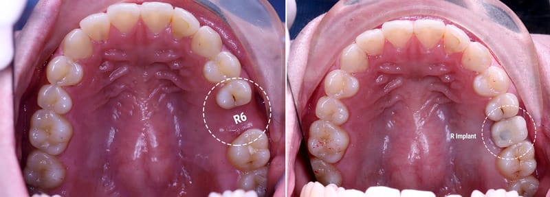 cấy ghép implant mất răng số 6 