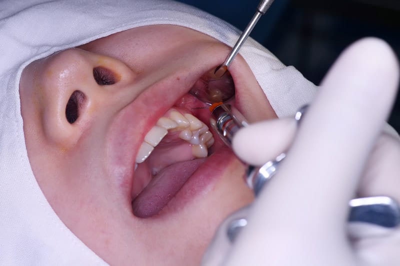 cấy ghép implant mất răng số 6 