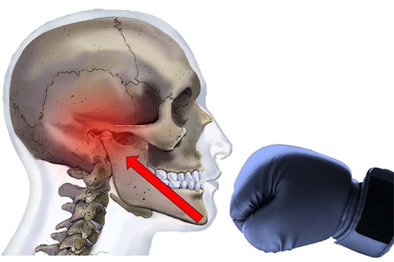 chân thương dẫn đến đau khớp thái dương hàm