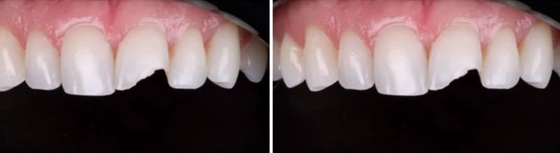 dán sứ veneer gãy răng cửa