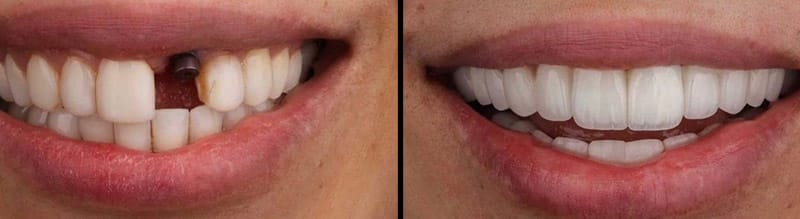 trồng răng implant cho răng cửa bị gãy