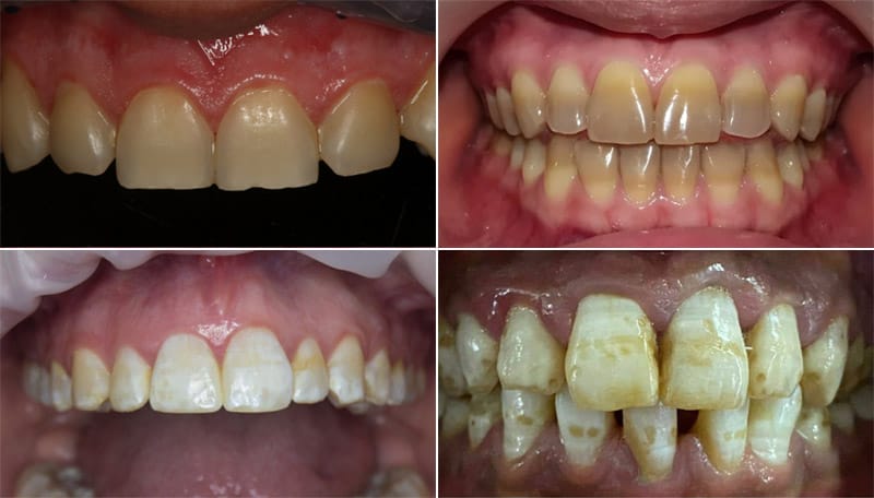 truong hop tay trang rang