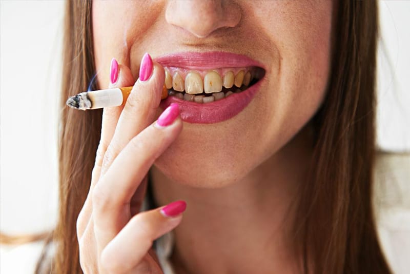 tẩy trắng răng kiêng hút thuốc lá