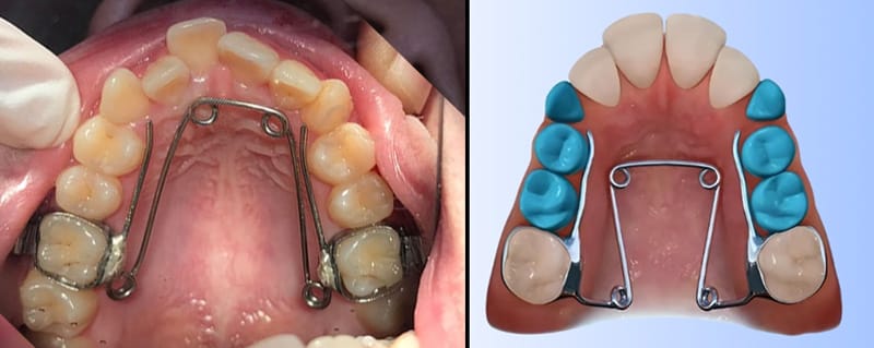 Khí cụ nong hàm Quad-helix