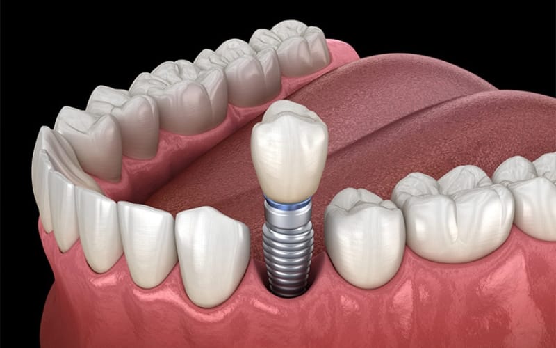 cấy ghép implant cho răng mất