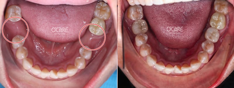 cấy ghép implant khi mất răng số 6