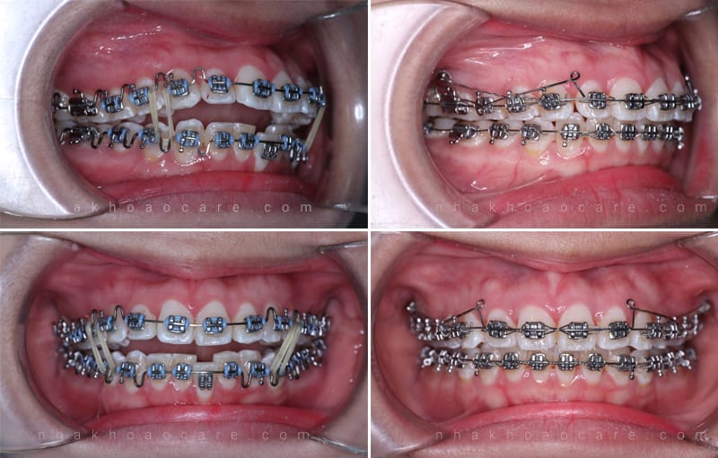 chỉnh răng hô bao lâu