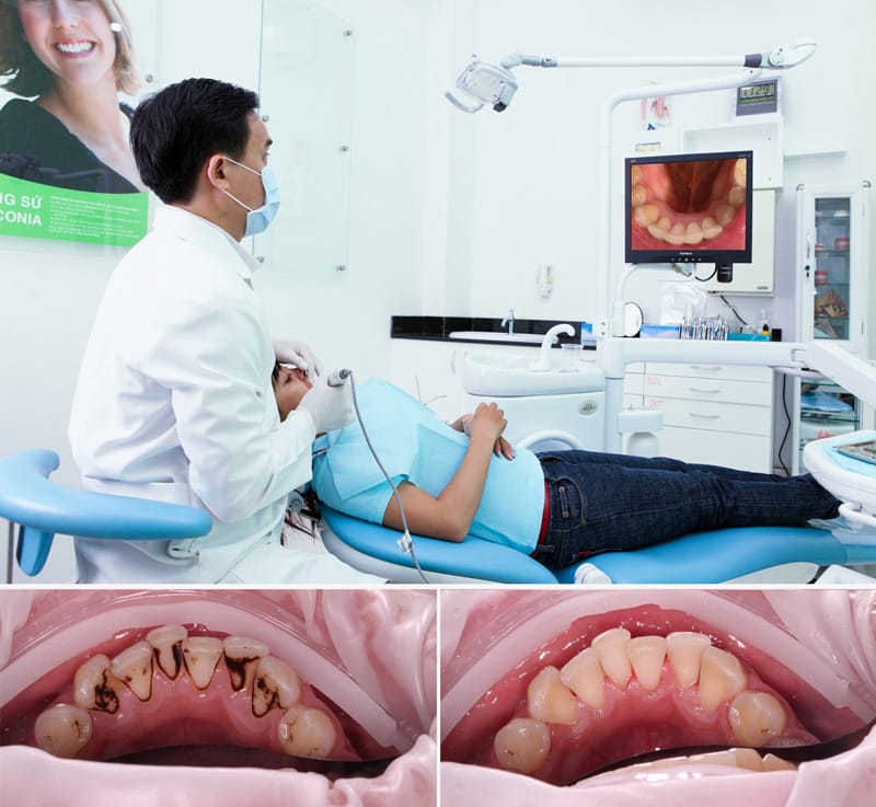 làm sạch mảng bám đen trên răng