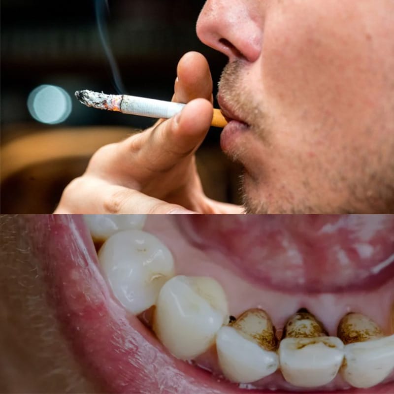 mảng bám đen trên răng do hút thuốc lá