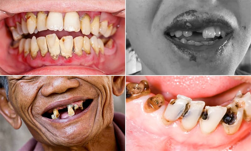 Các nguyên nhân gây mất răng