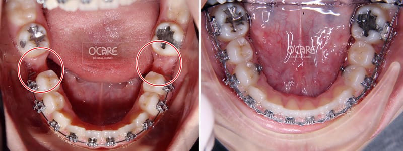 niềng răng mất răng số 6