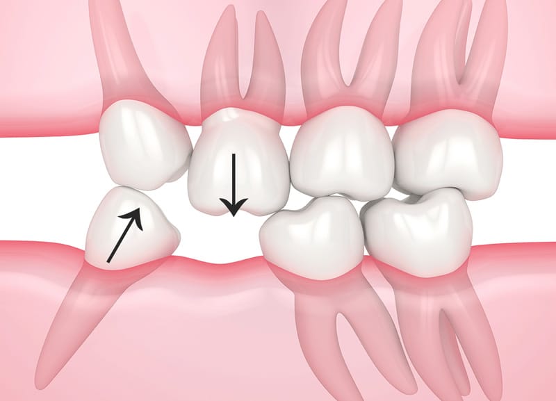 tác hại mất răng số 6