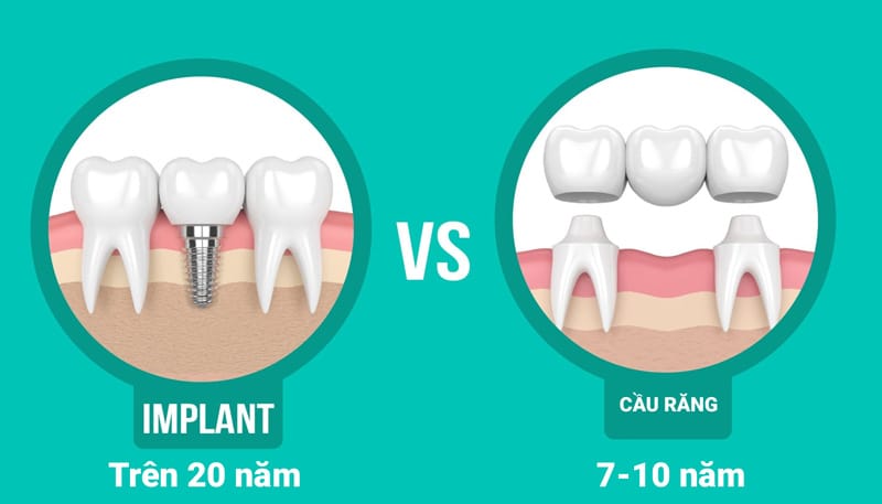 trồng răng giả vĩnh viễn