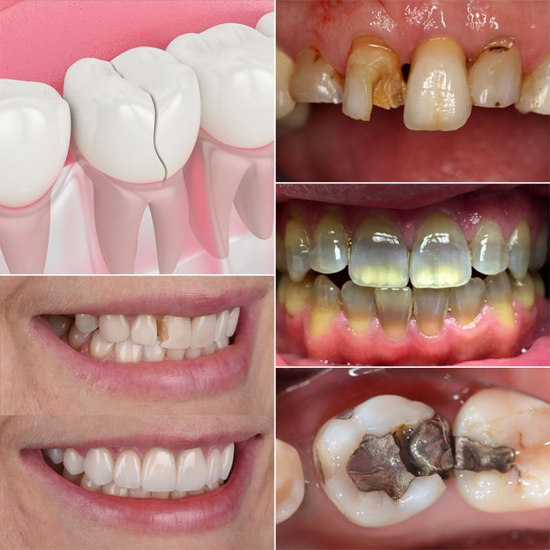 Dental Crowns cases