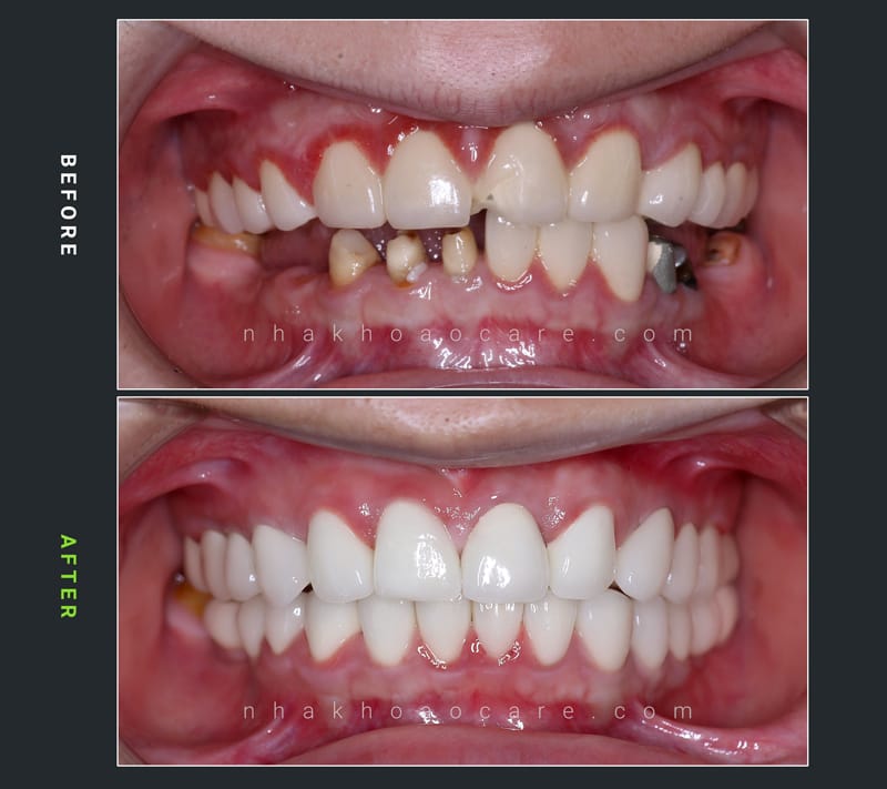 Dental Crowns in Ho Chi Minh City