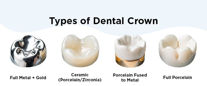 Dental Crowns types