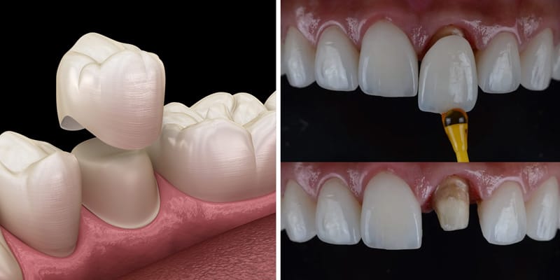 Dental Crowns