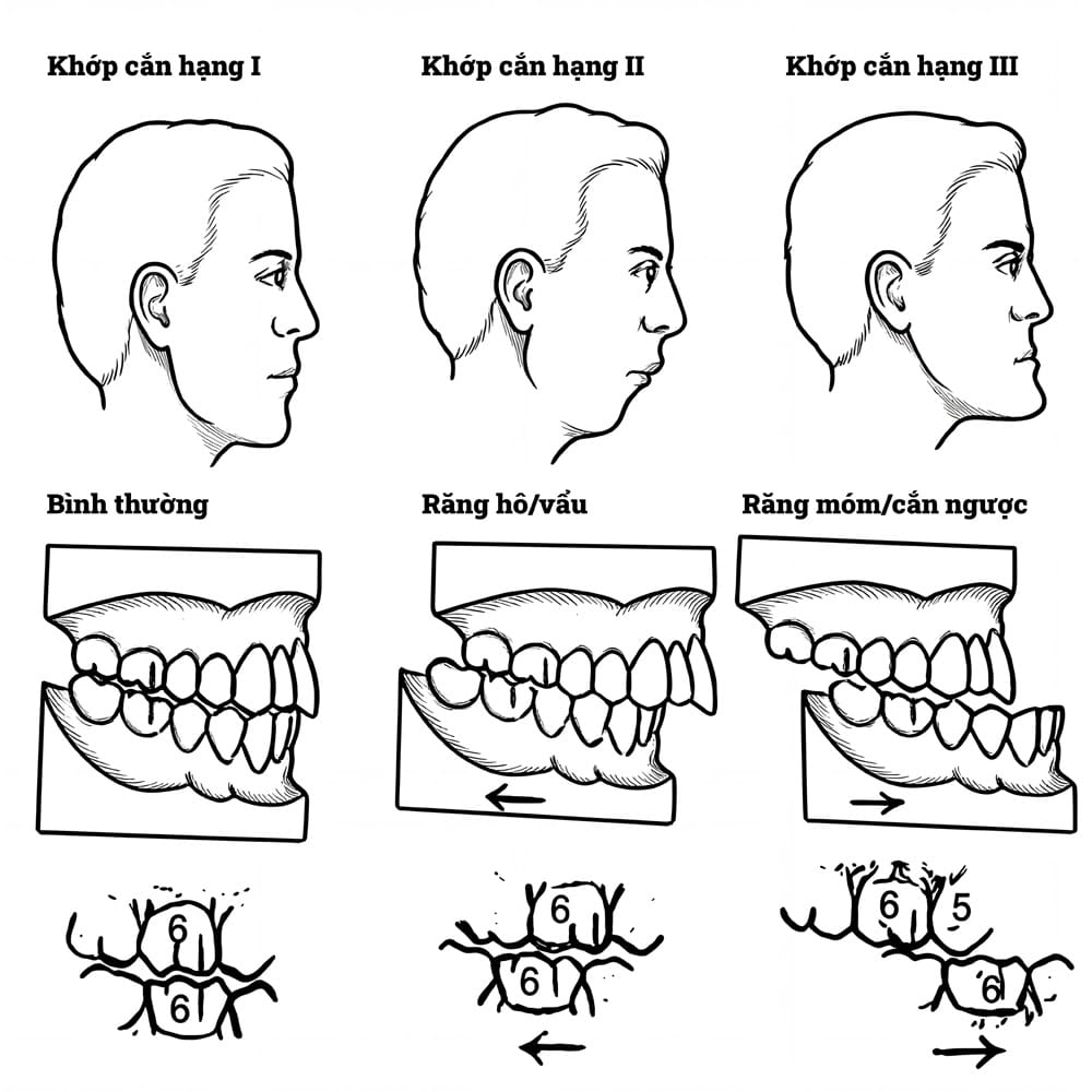 khớp cắn hạng 1 2 3