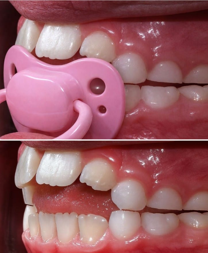 ảnh hưởng của núm vú giả đối với răng trẻ em