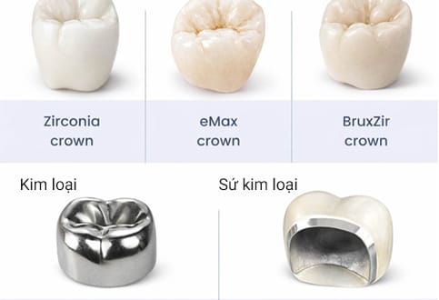 các loại răng sứ