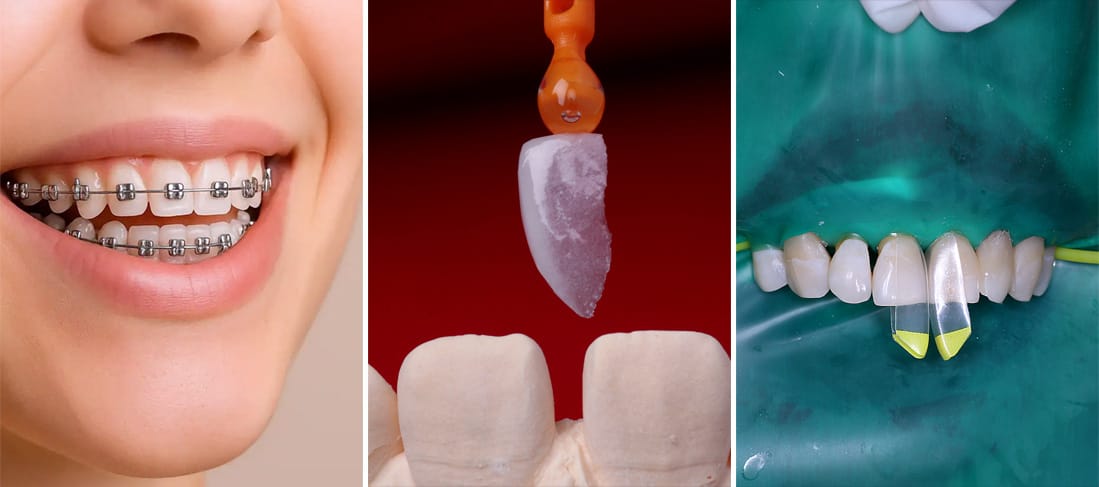 các phương pháp thay thế bọc răng sứ