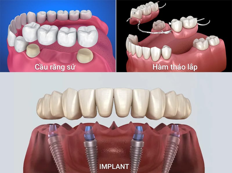 các phương pháp trồng răng cho người già