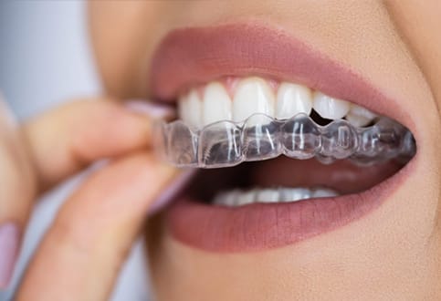 clear aligners Ho Chi Minh City