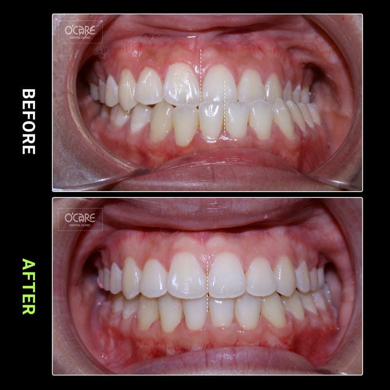 điều trị lệch hàm 