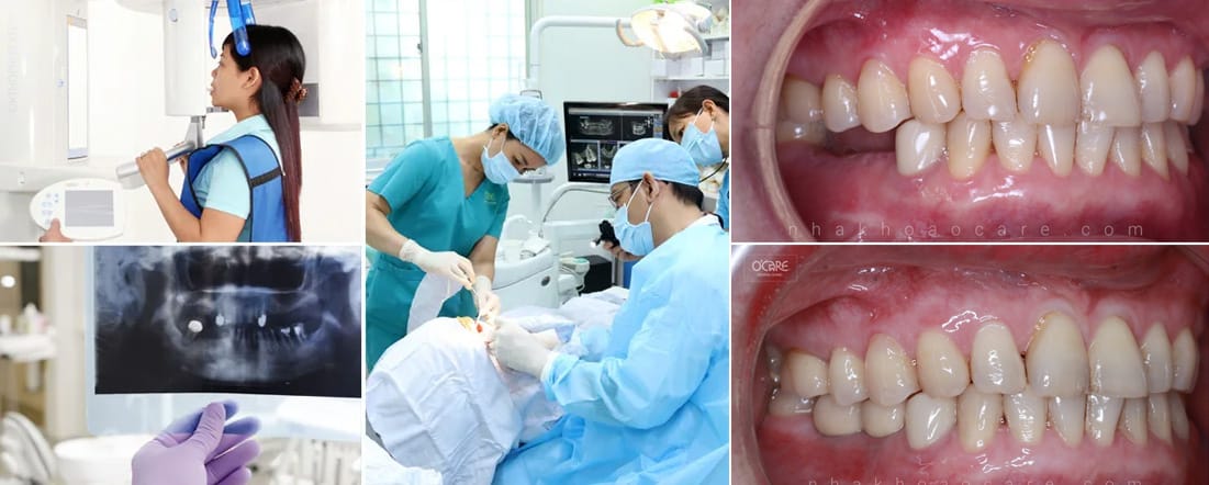 giá trồng răng implant 3