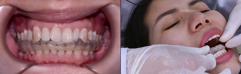 Máng nhai định vị điều trị khớp thái dương hàm