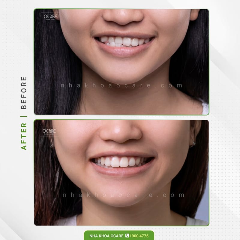 niềng răng điều trị lệch hàm (1)