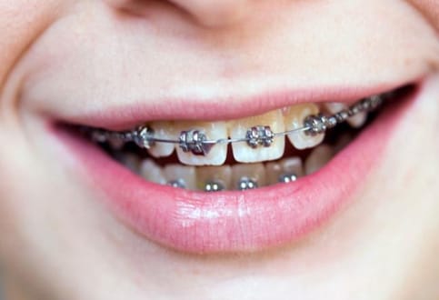 niềng răng mắc cài kim loại