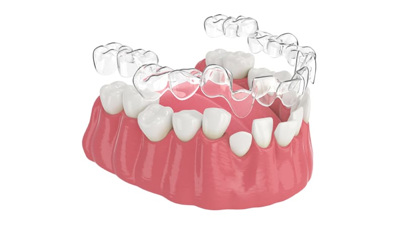 niềng răng trong suốt Ocalign 2