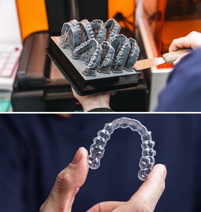 niềng răng trong suốt Ocalign 4