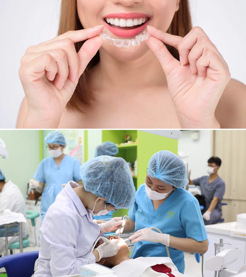 niềng răng trong suốt Ocalign 5