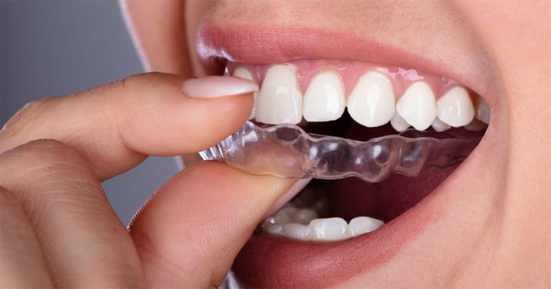 niềng răng trong suốt Ocalign