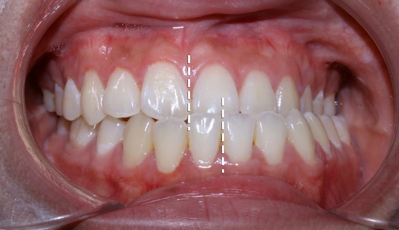 răng lệch đường giữa - lệch hàm
