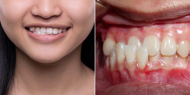 răng lệch lạc cắn ngược cần niềng răng