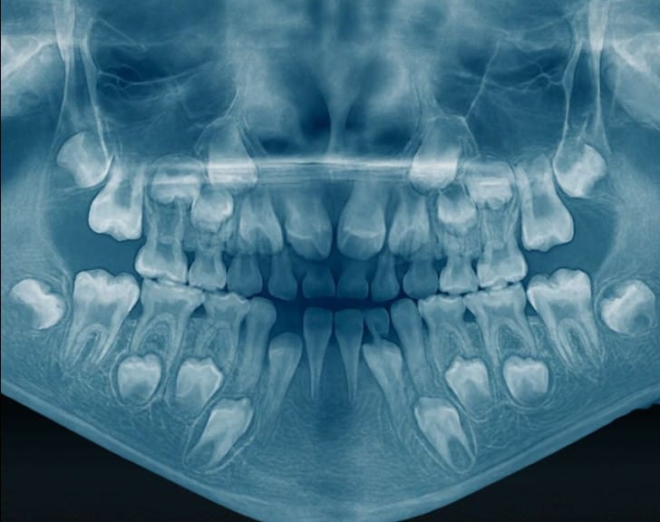 răng sữa qua phim xquang