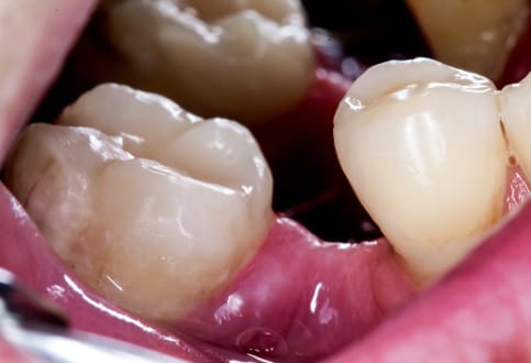 tiêu xương do mất rănng