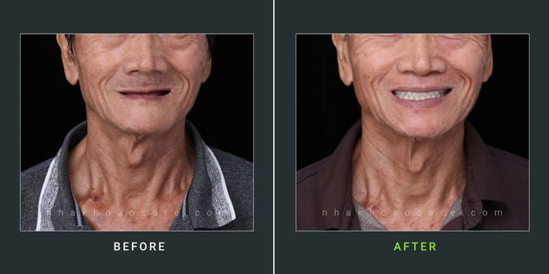 trồng răng cho người già