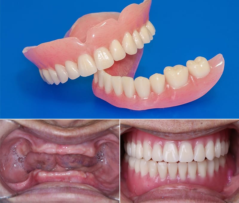 trồng răng giả tháo lắp cho người già