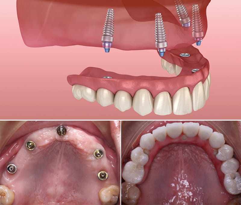 trồng răng implant cho người già