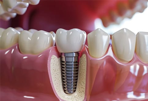trồng răng implant gia bao nhiêu 2