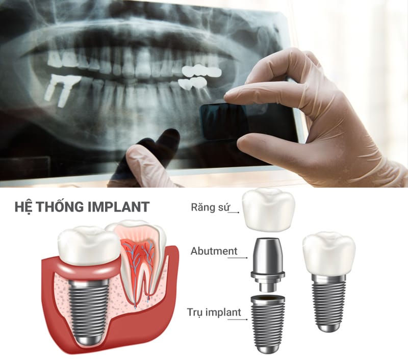 trồng răng implant gia bao nhiêu